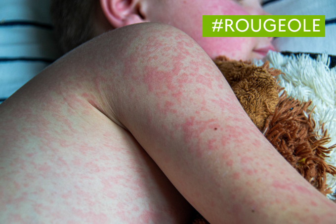 Morbillo: recrudescenza dei casi in Francia