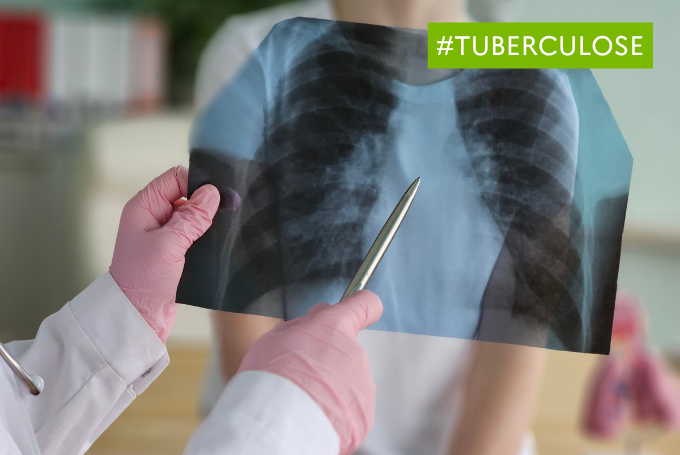 Hausse des cas de tuberculose : comment se protéger efficacement contre la maladie ?